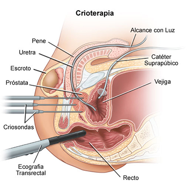 crioterapie pentru prostatită tratamentul prostatei prin anus
